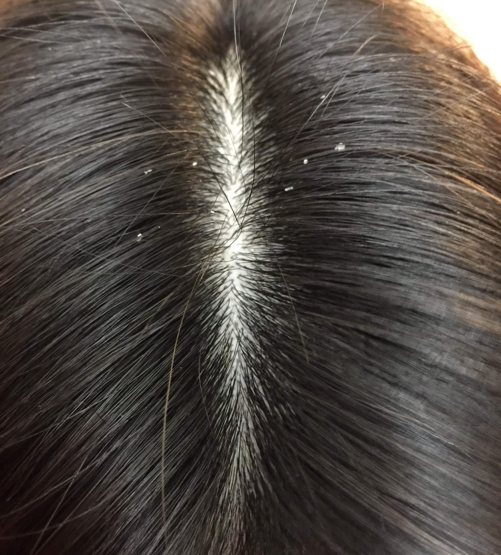 頭皮に見えるフケの写真。乾燥や脂性によるフケ対策が必要な頭皮の状態